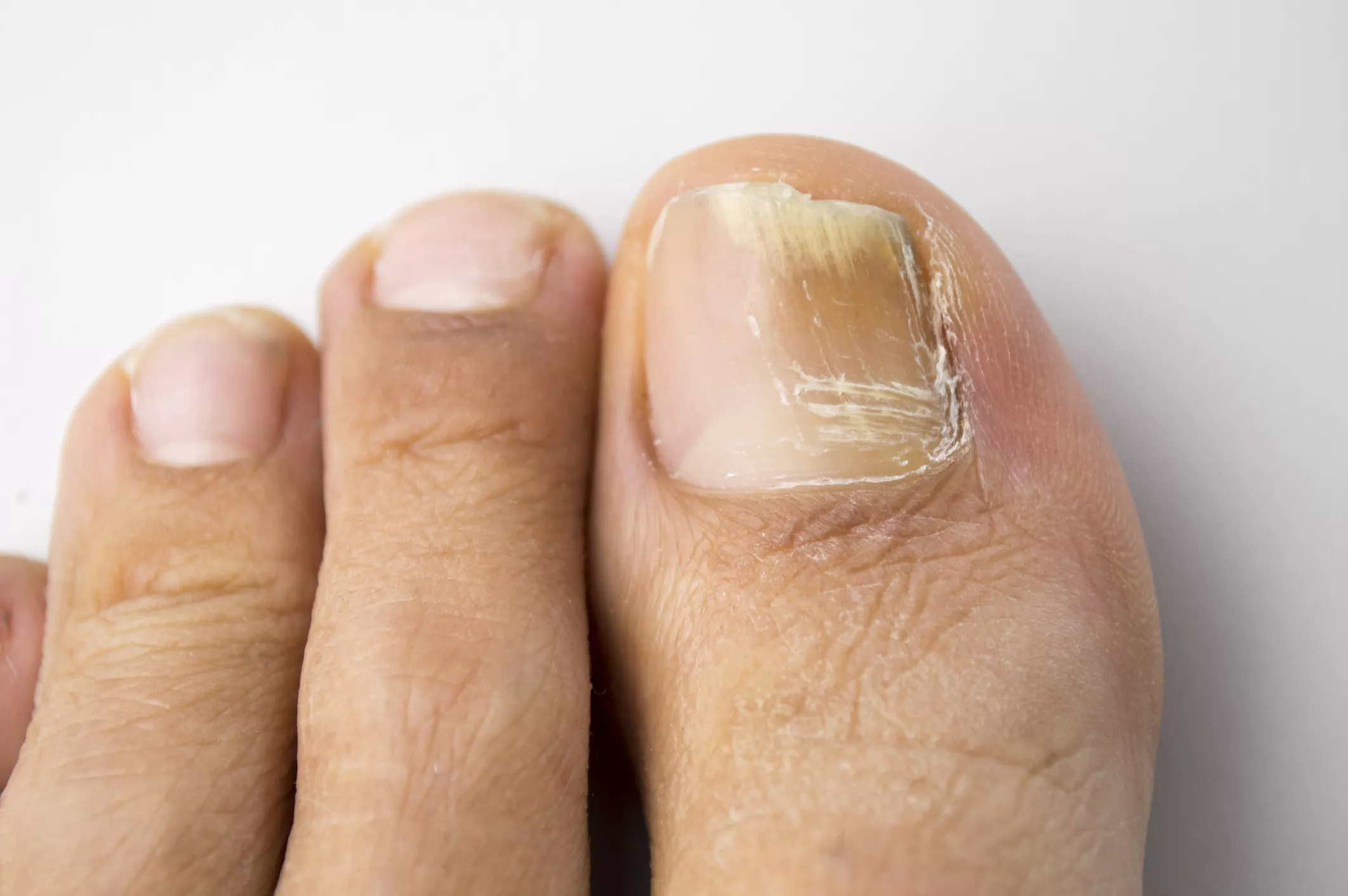 Nail fungus affects one or more nails.